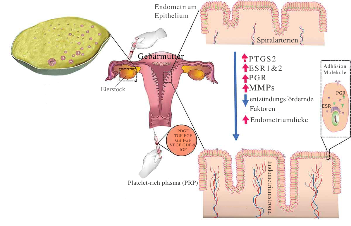Die mutmaßliche Rolle von plättchenreichem Plasma (PRP) auf die Empfänglichkeit des Endometriums und die Ovarialfunktion.